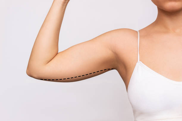 armlift pic, is arm-lift right for you?