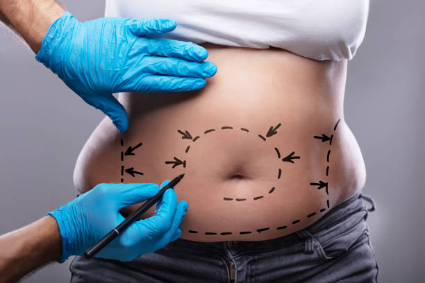 abdominoplasty-surgery in cheadle,uk. is abdominoplasty-surgery right for you?