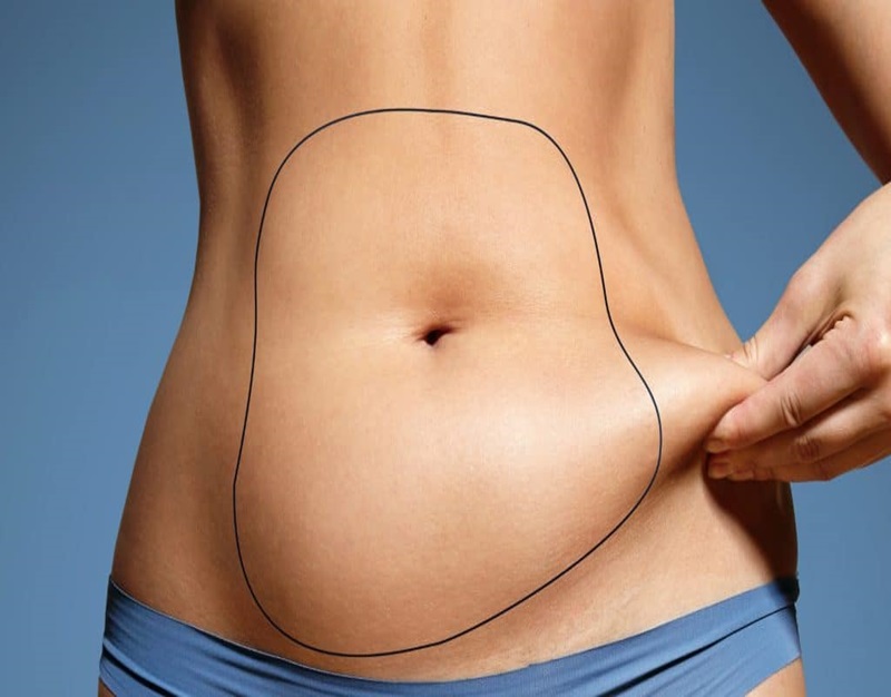Liposuction-surgery-in-cheadle-dr-ayub-plastic-surgery