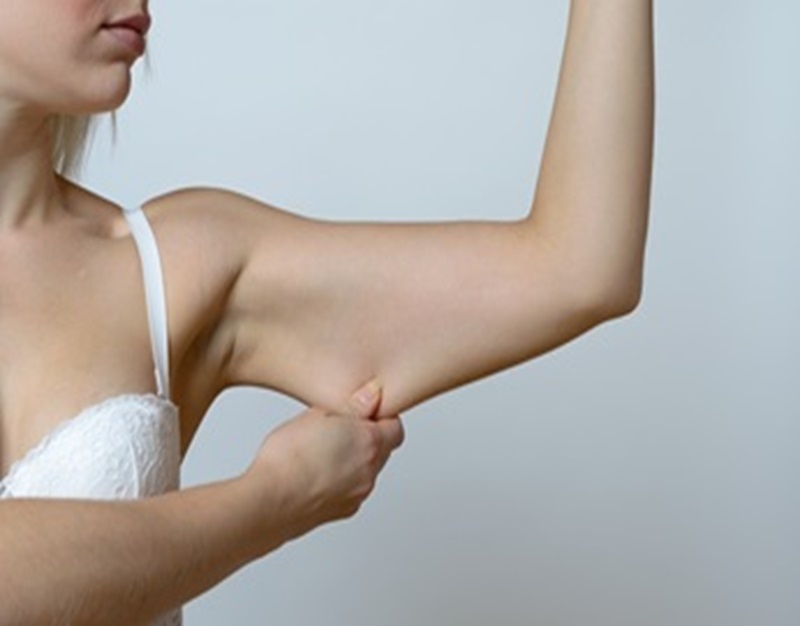 Dr ayub plastic surgery arm-lift-surgery-in-Cheadle